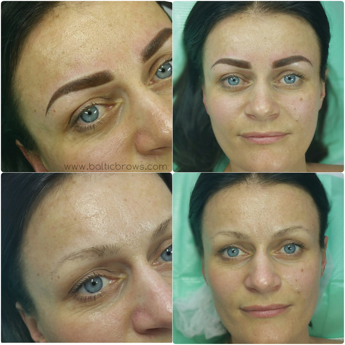 Needle Brow Results
